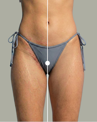 The Ultimate Guide to Intimate Area Shaving: How to Prevent Razor Bumps, Irritation, and Razor Burn